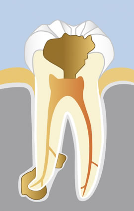 Endodontie: Durch eine bakterielle Infektion zersetzter Zahn
