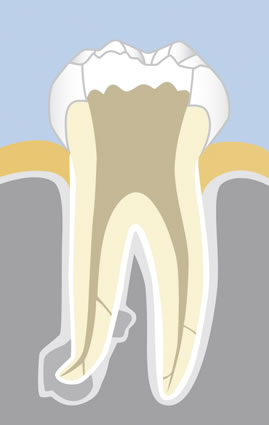 Endodontie: Spülung der Wurzelkanaleingänge des Zahninneren
