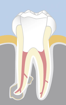 Endodontie: Reinigung der Wurzelkanäle und thermoplastische Wurzelfüllung