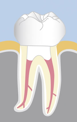 Endodontie: Bakteriendichter Verschluss mit adhäsiver Füllung